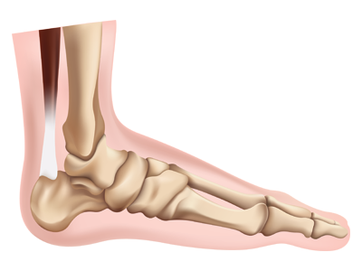 Ankle Fractures