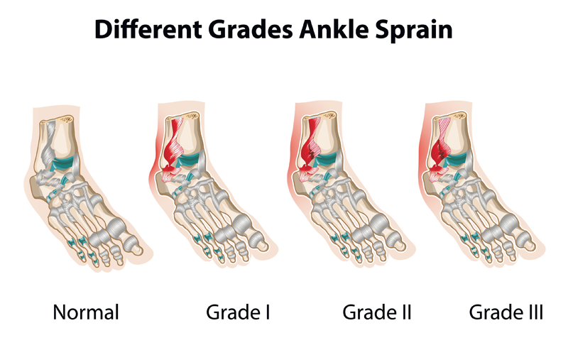 Ankle Sprain or Fracture - Murrell Orthopedics